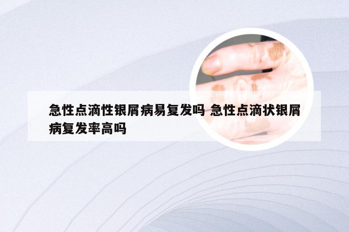 急性点滴性银屑病易复发吗 急性点滴状银屑病复发率高吗