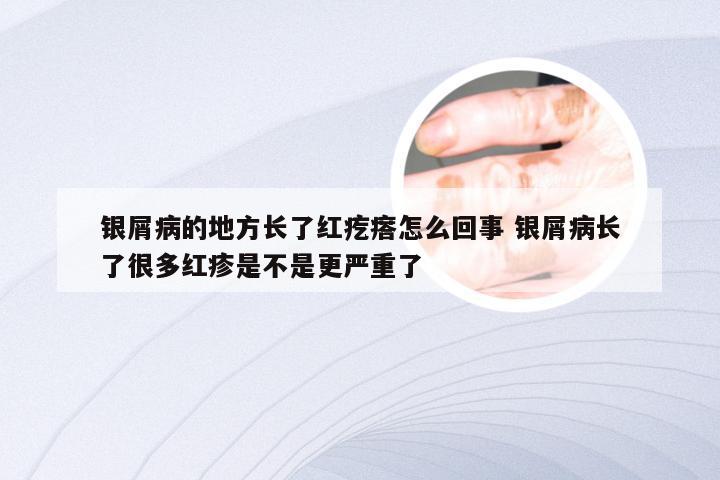 银屑病的地方长了红疙瘩怎么回事 银屑病长了很多红疹是不是更严重了