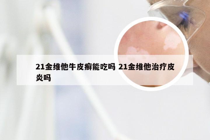 21金维他牛皮癣能吃吗 21金维他治疗皮炎吗