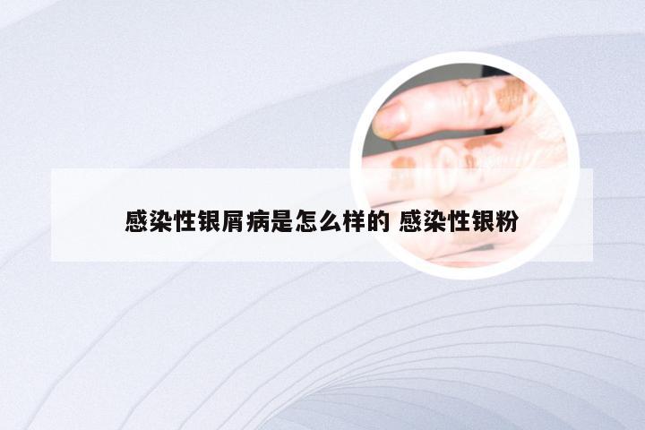 感染性银屑病是怎么样的 感染性银粉