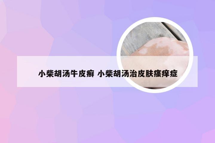 小柴胡汤牛皮癣 小柴胡汤治皮肤瘙痒症