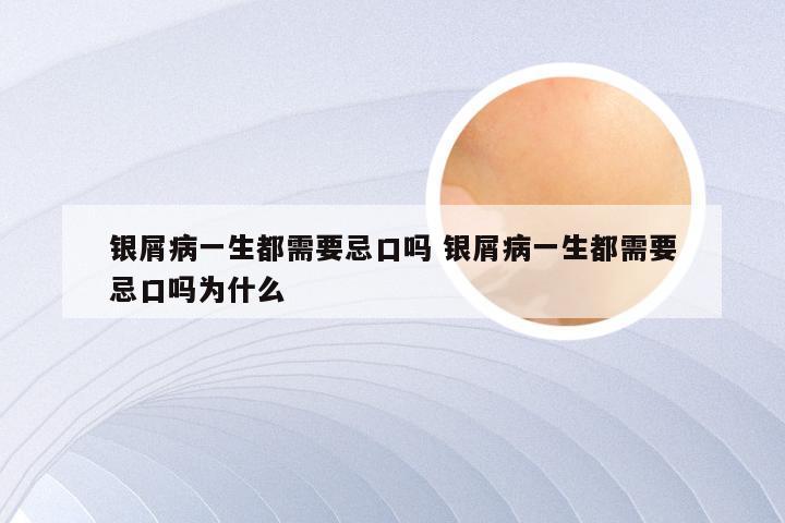 银屑病一生都需要忌口吗 银屑病一生都需要忌口吗为什么