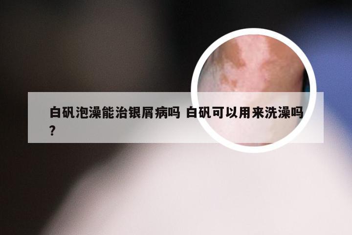 白矾泡澡能治银屑病吗 白矾可以用来洗澡吗?