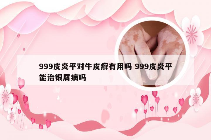 999皮炎平对牛皮癣有用吗 999皮炎平能治银屑病吗