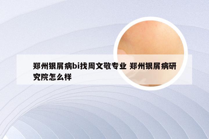 郑州银屑病bi找周文敬专业 郑州银屑病研究院怎么样