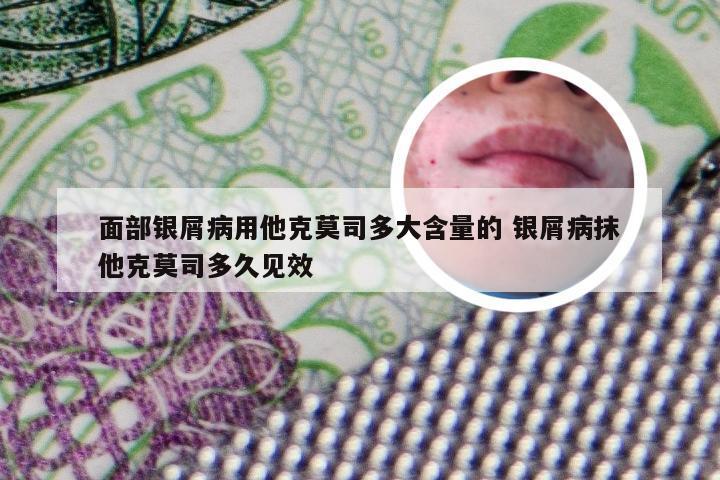 面部银屑病用他克莫司多大含量的 银屑病抹他克莫司多久见效