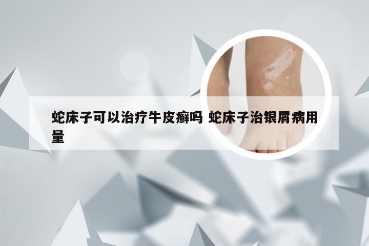 蛇床子可以治疗牛皮癣吗 蛇床子治银屑病用量