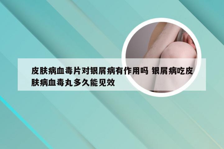 皮肤病血毒片对银屑病有作用吗 银屑病吃皮肤病血毒丸多久能见效