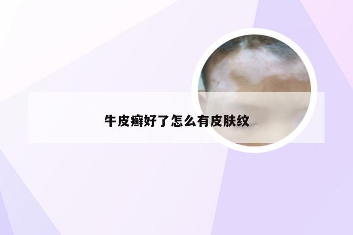 牛皮癣好了怎么有皮肤纹