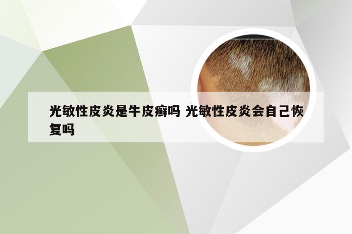 光敏性皮炎是牛皮癣吗 光敏性皮炎会自己恢复吗