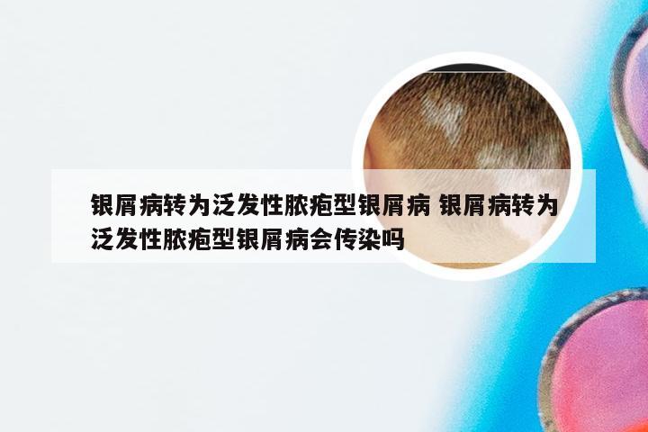 银屑病转为泛发性脓疱型银屑病 银屑病转为泛发性脓疱型银屑病会传染吗