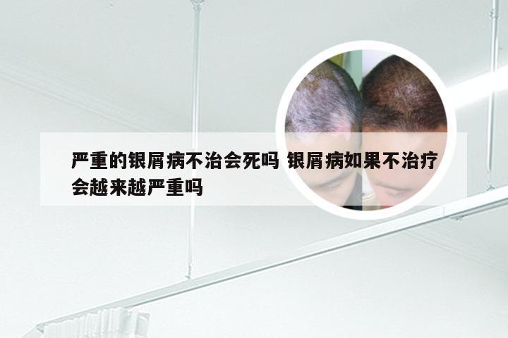 严重的银屑病不治会死吗 银屑病如果不治疗会越来越严重吗