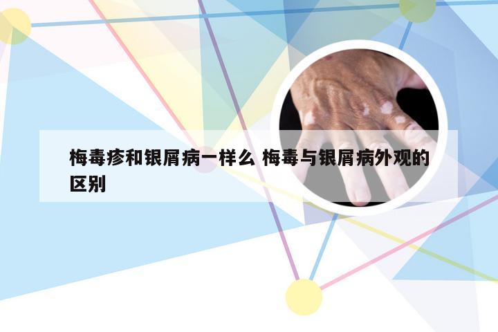 梅毒疹和银屑病一样么 梅毒与银屑病外观的区别