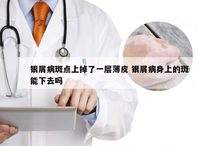 银屑病斑点上掉了一层薄皮 银屑病身上的斑能下去吗