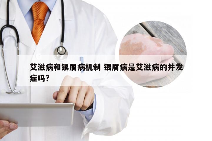 艾滋病和银屑病机制 银屑病是艾滋病的并发症吗?