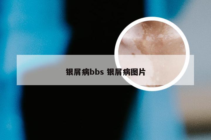 银屑病bbs 银屑病图片