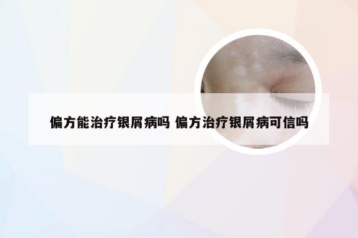 偏方能治疗银屑病吗 偏方治疗银屑病可信吗