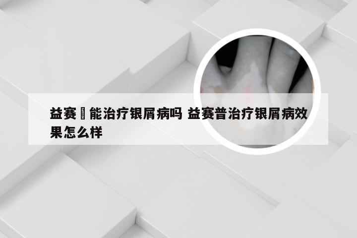 益赛譜能治疗银屑病吗 益赛普治疗银屑病效果怎么样