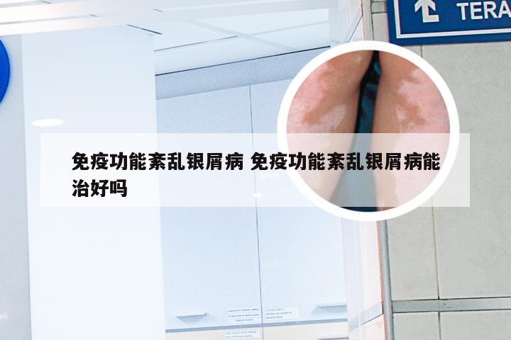 免疫功能紊乱银屑病 免疫功能紊乱银屑病能治好吗