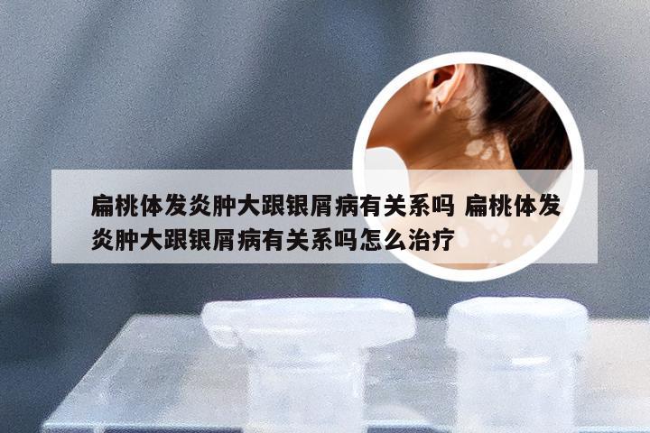 扁桃体发炎肿大跟银屑病有关系吗 扁桃体发炎肿大跟银屑病有关系吗怎么治疗