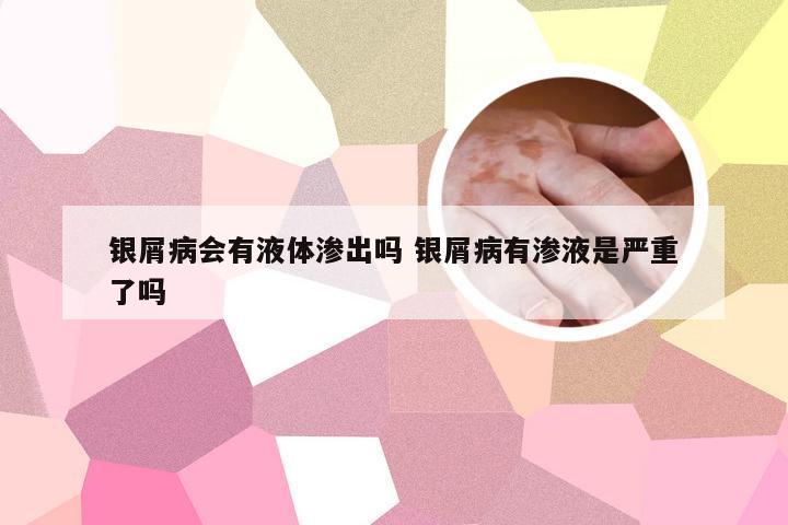 银屑病会有液体渗出吗 银屑病有渗液是严重了吗