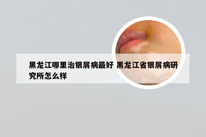 黑龙江哪里治银屑病最好 黑龙江省银屑病研究所怎么样