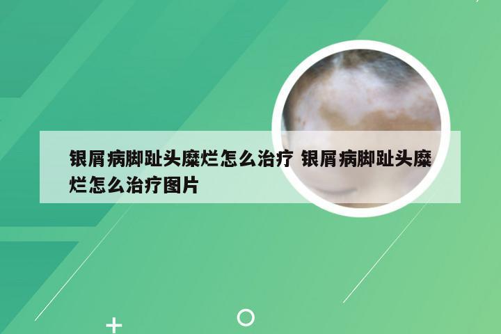 银屑病脚趾头糜烂怎么治疗 银屑病脚趾头糜烂怎么治疗图片