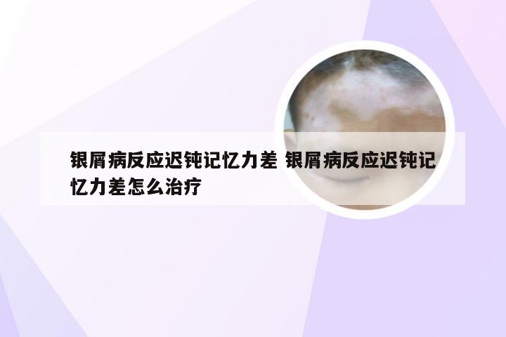 银屑病反应迟钝记忆力差 银屑病反应迟钝记忆力差怎么治疗