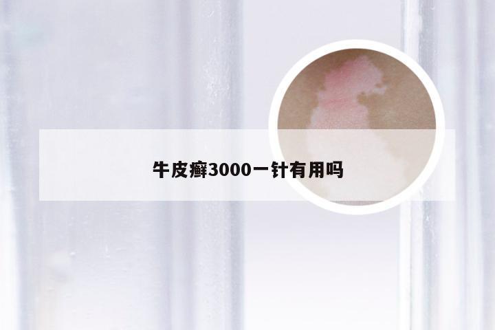 牛皮癣3000一针有用吗