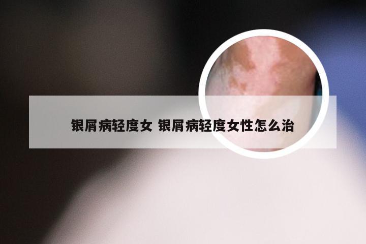 银屑病轻度女 银屑病轻度女性怎么治