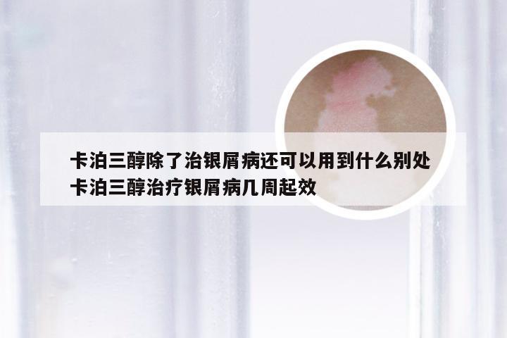 卡泊三醇除了治银屑病还可以用到什么别处 卡泊三醇治疗银屑病几周起效