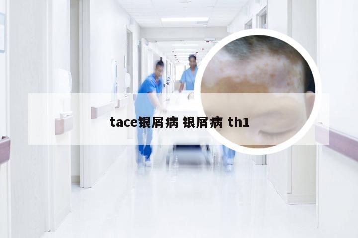 tace银屑病 银屑病 th1