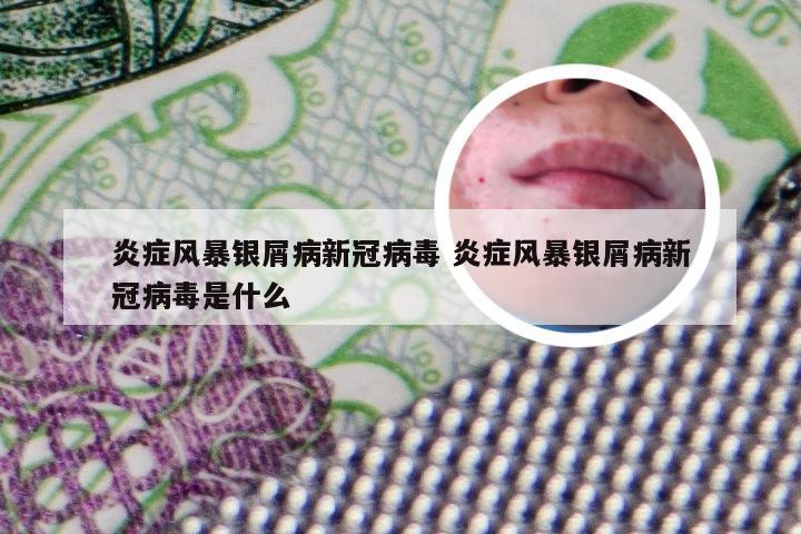 炎症风暴银屑病新冠病毒 炎症风暴银屑病新冠病毒是什么