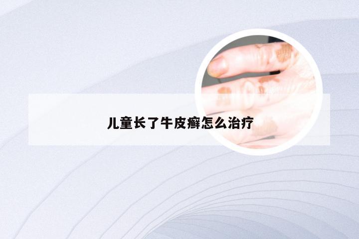 儿童长了牛皮癣怎么治疗