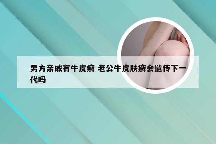 男方亲戚有牛皮癣 老公牛皮肤癣会遗传下一代吗