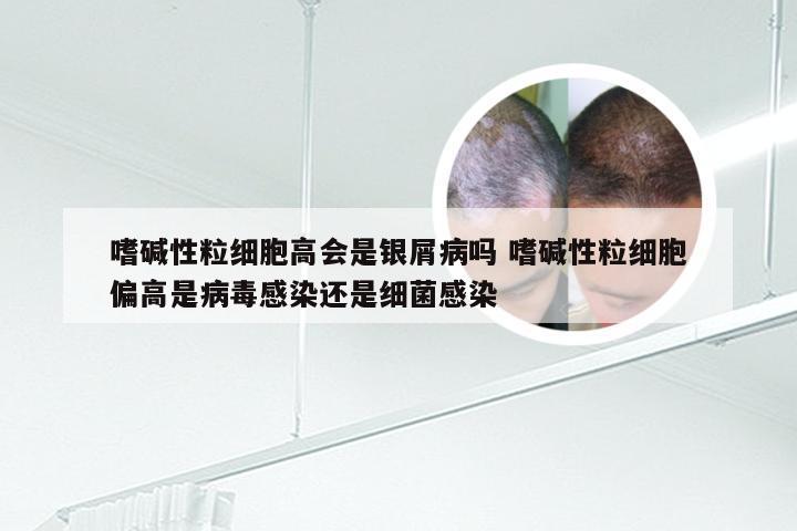 嗜碱性粒细胞高会是银屑病吗 嗜碱性粒细胞偏高是病毒感染还是细菌感染