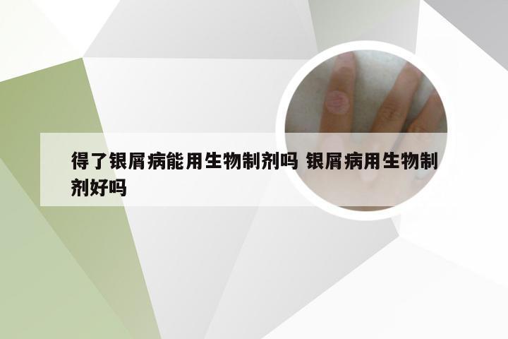 得了银屑病能用生物制剂吗 银屑病用生物制剂好吗