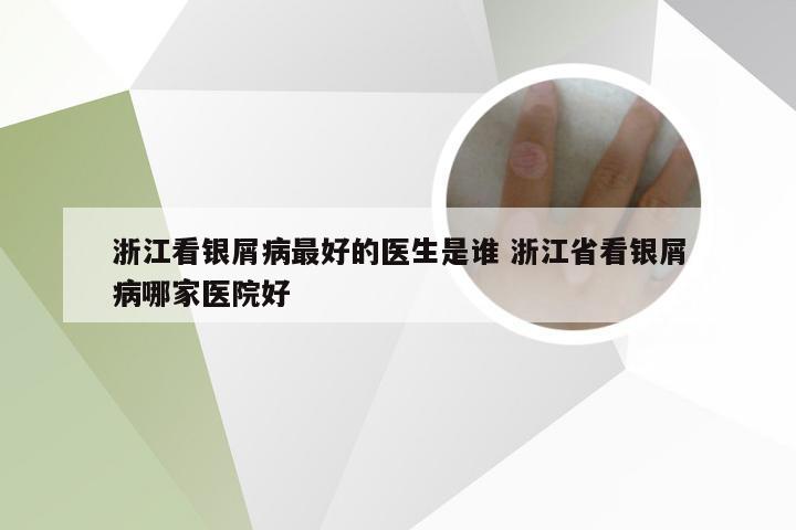 浙江看银屑病最好的医生是谁 浙江省看银屑病哪家医院好