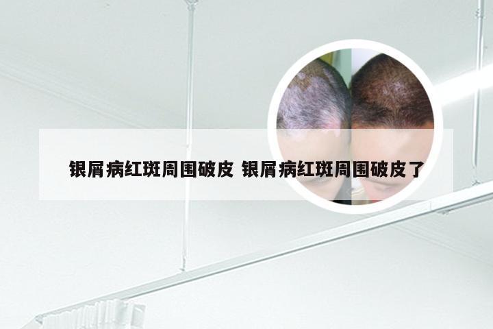 银屑病红斑周围破皮 银屑病红斑周围破皮了