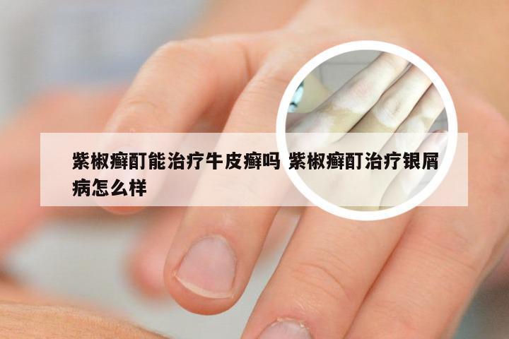 紫椒癣酊能治疗牛皮癣吗 紫椒癣酊治疗银屑病怎么样