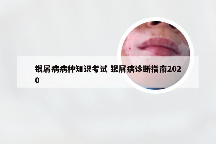 银屑病病种知识考试 银屑病诊断指南2020