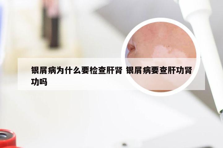 银屑病为什么要检查肝肾 银屑病要查肝功肾功吗