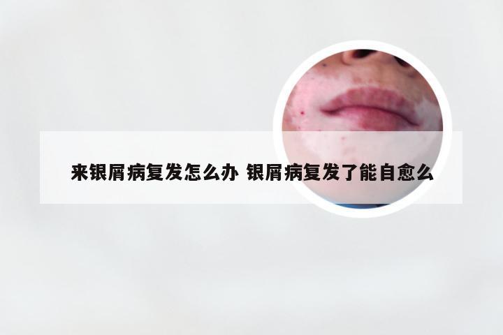 来银屑病复发怎么办 银屑病复发了能自愈么