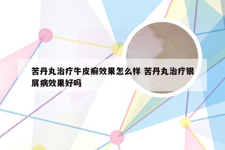 苦丹丸治疗牛皮癣效果怎么样 苦丹丸治疗银屑病效果好吗