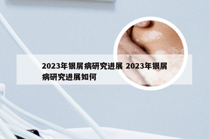 2023年银屑病研究进展 2023年银屑病研究进展如何