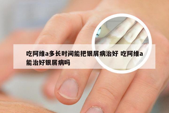 吃阿维a多长时间能把银屑病治好 吃阿维a能治好银屑病吗