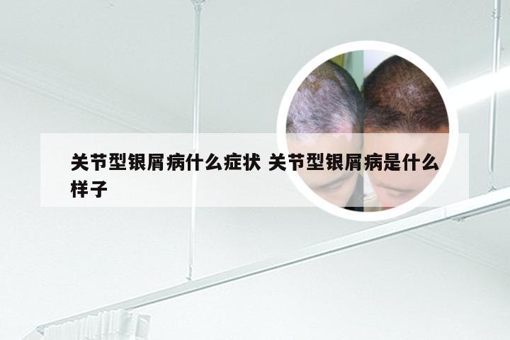 关节型银屑病什么症状 关节型银屑病是什么样子