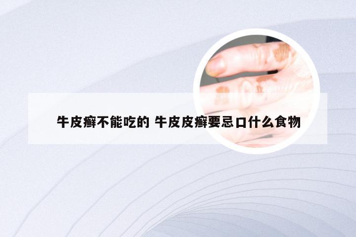 牛皮癣不能吃的 牛皮皮癣要忌口什么食物