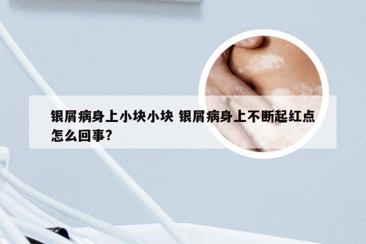 银屑病身上小块小块 银屑病身上不断起红点怎么回事?