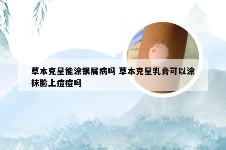 草本克星能涂银屑病吗 草本克星乳膏可以涂抹脸上痘痘吗